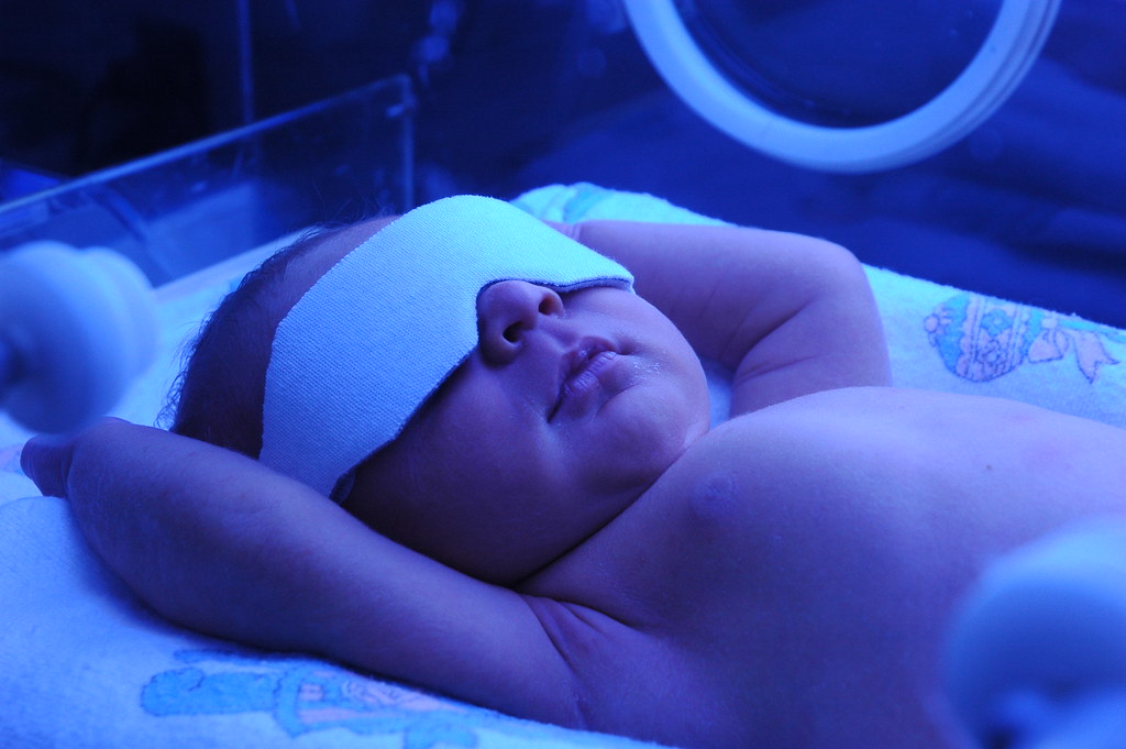 Phototherapy Time for Jaundice